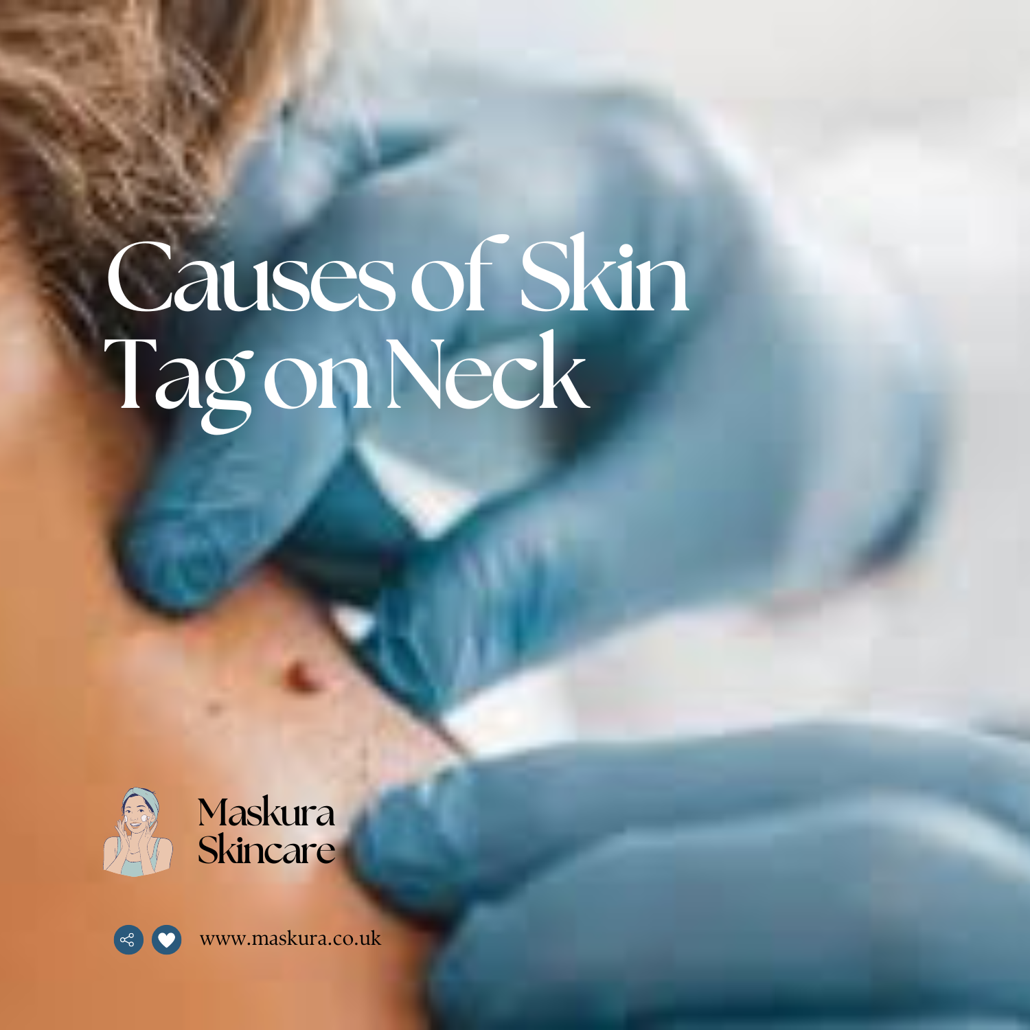 Skin Tag on Neck