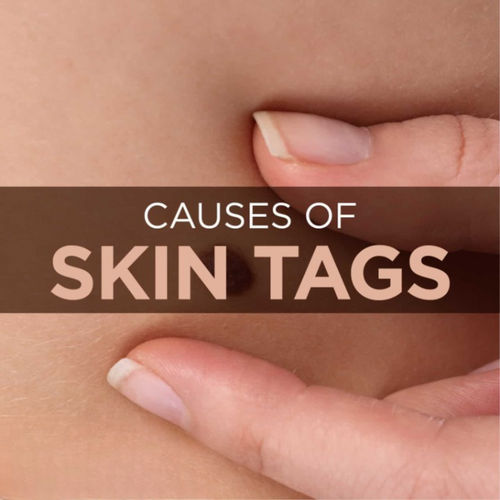 Causes of skin tags