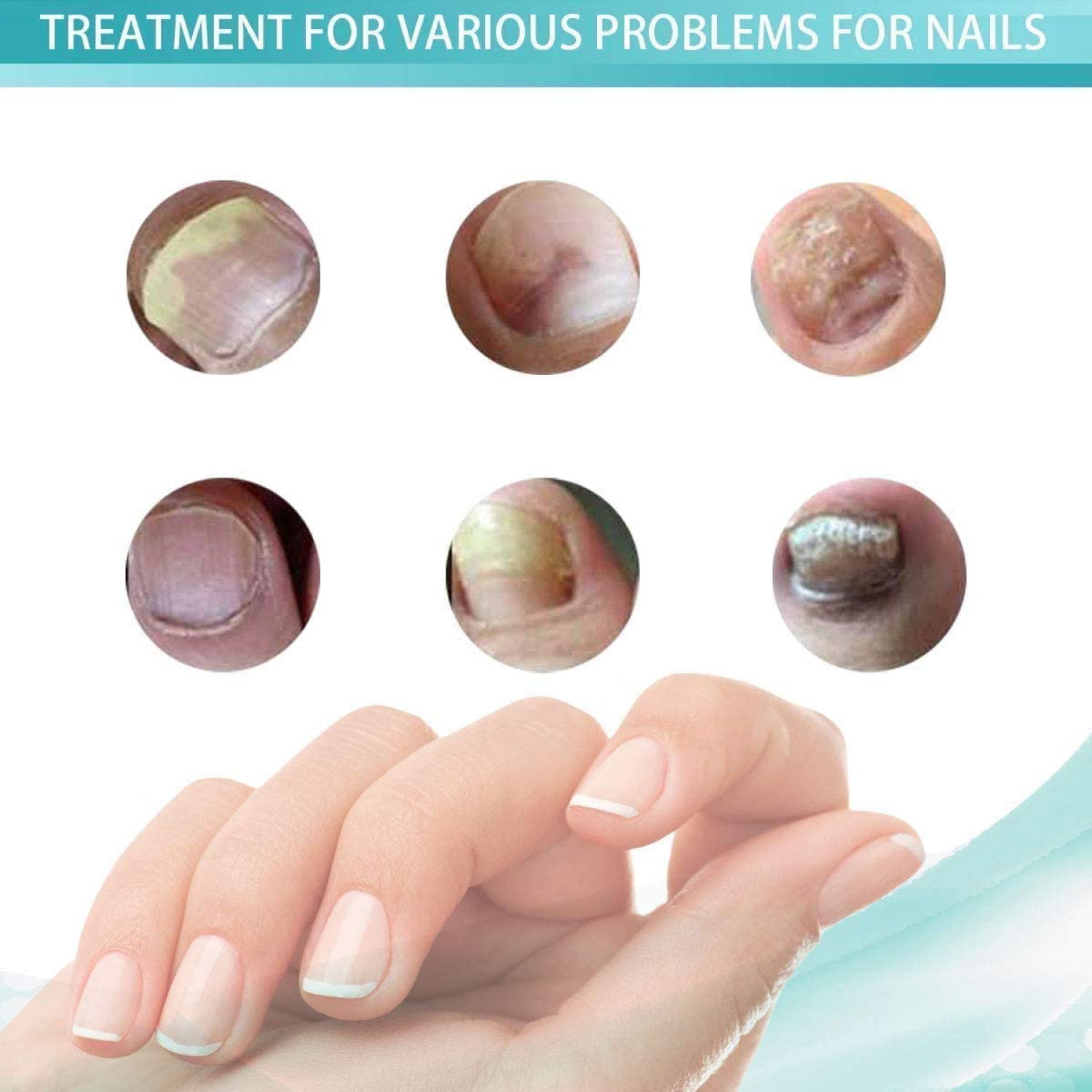 Toenail Fungus Cure